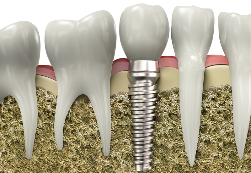 dental implants in legacy