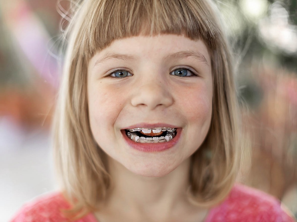 what are the benefits of early orthodontics
